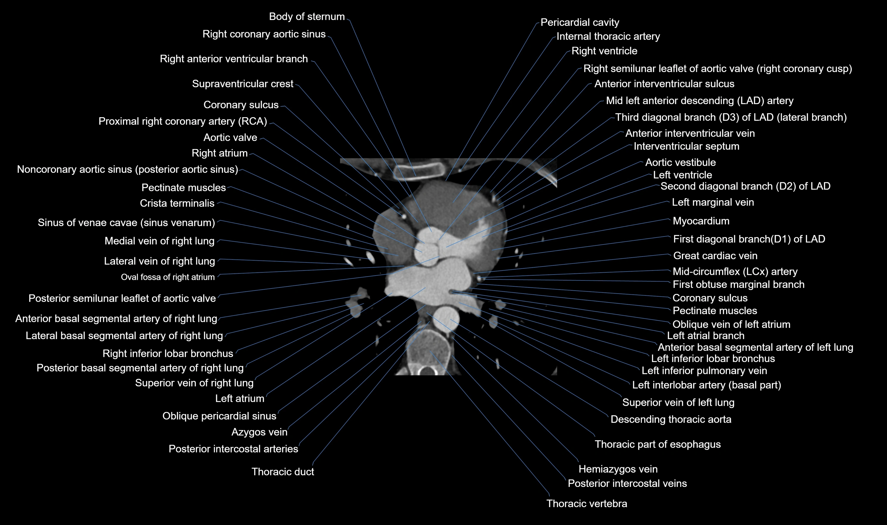 CT heart (coronary angiogram) axial view cross sectional anatomy labelled radiology image-00031.webp